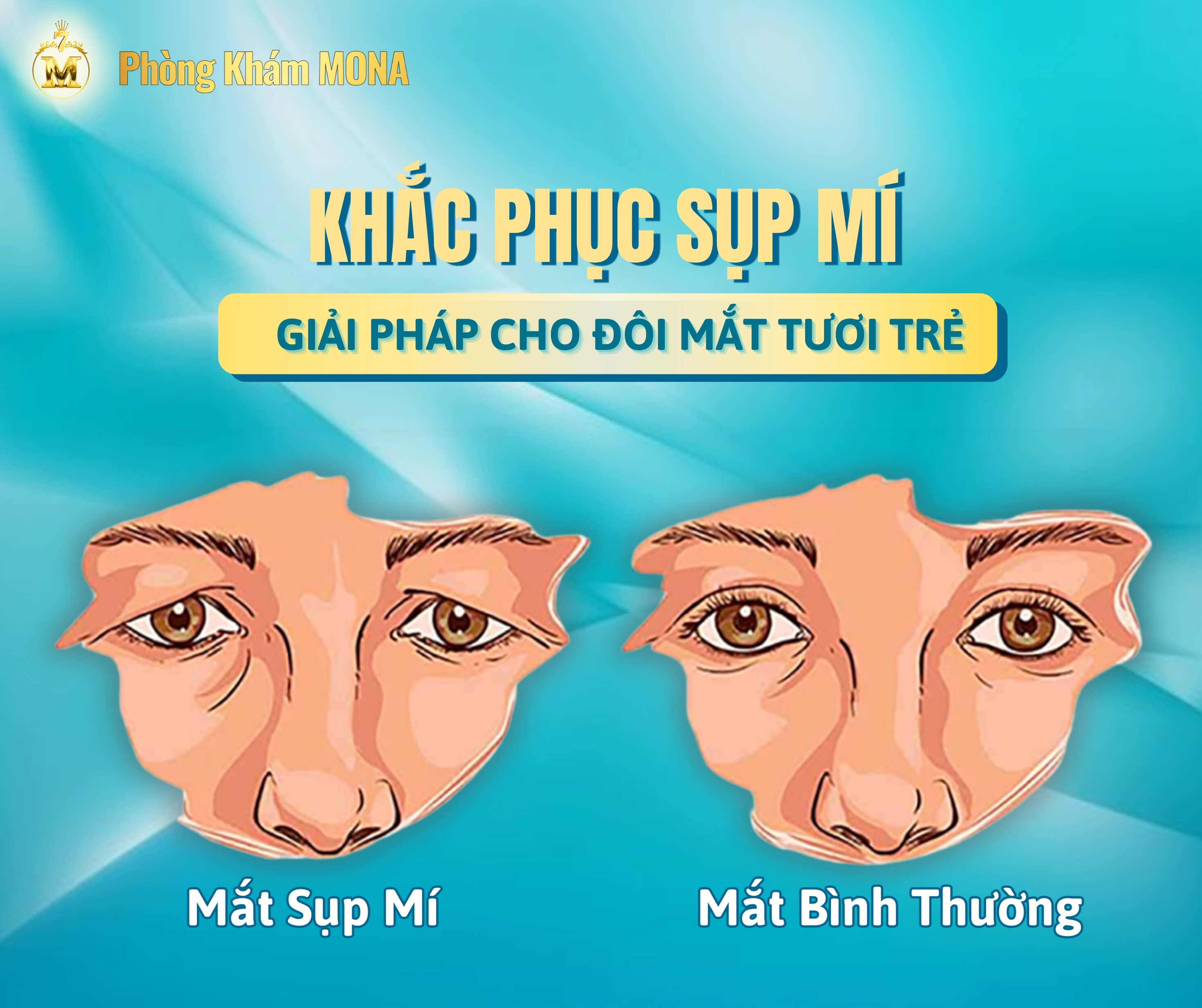 Khac phuc mi sup la gi