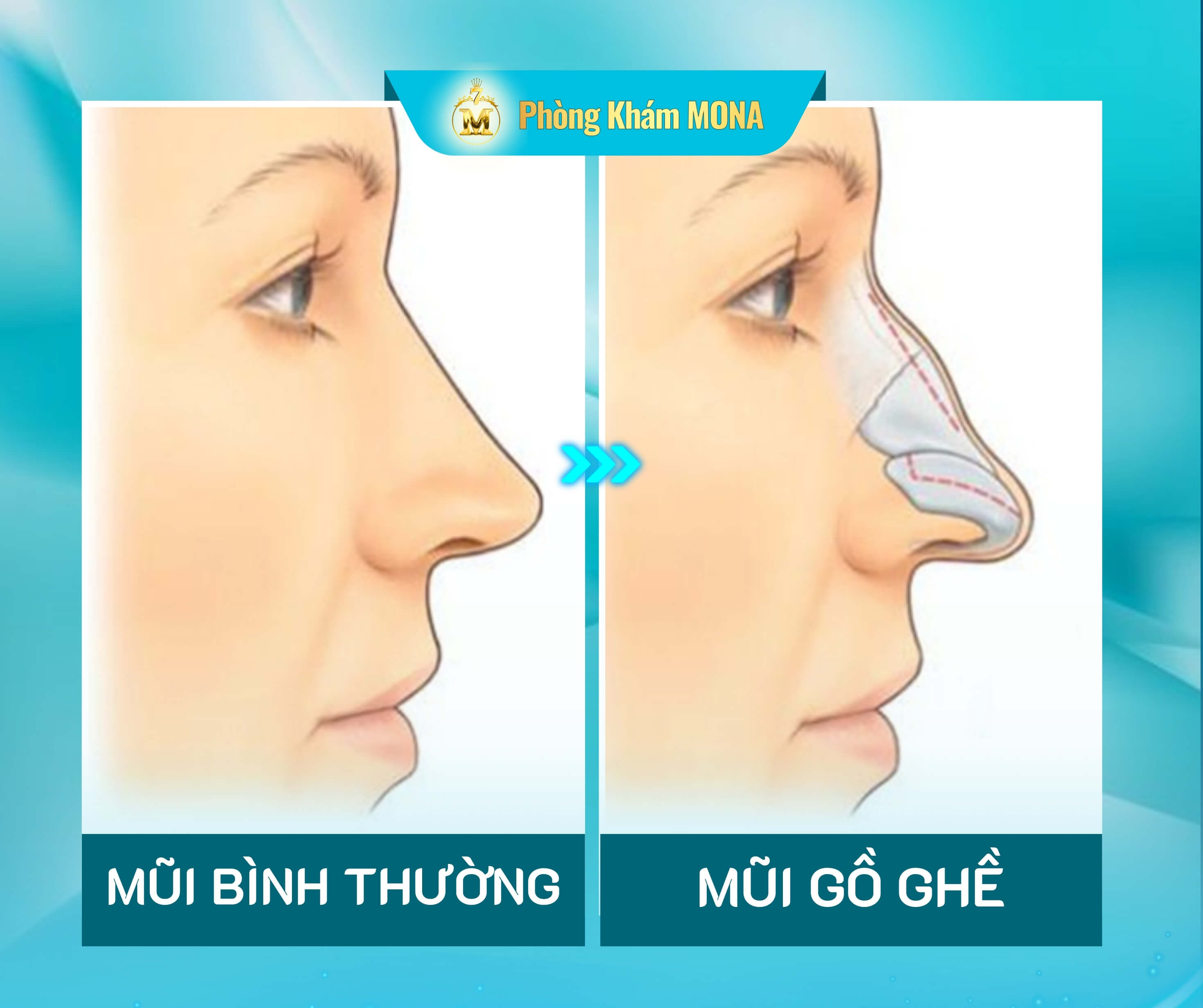 Mui binh thuong va mui go ghe