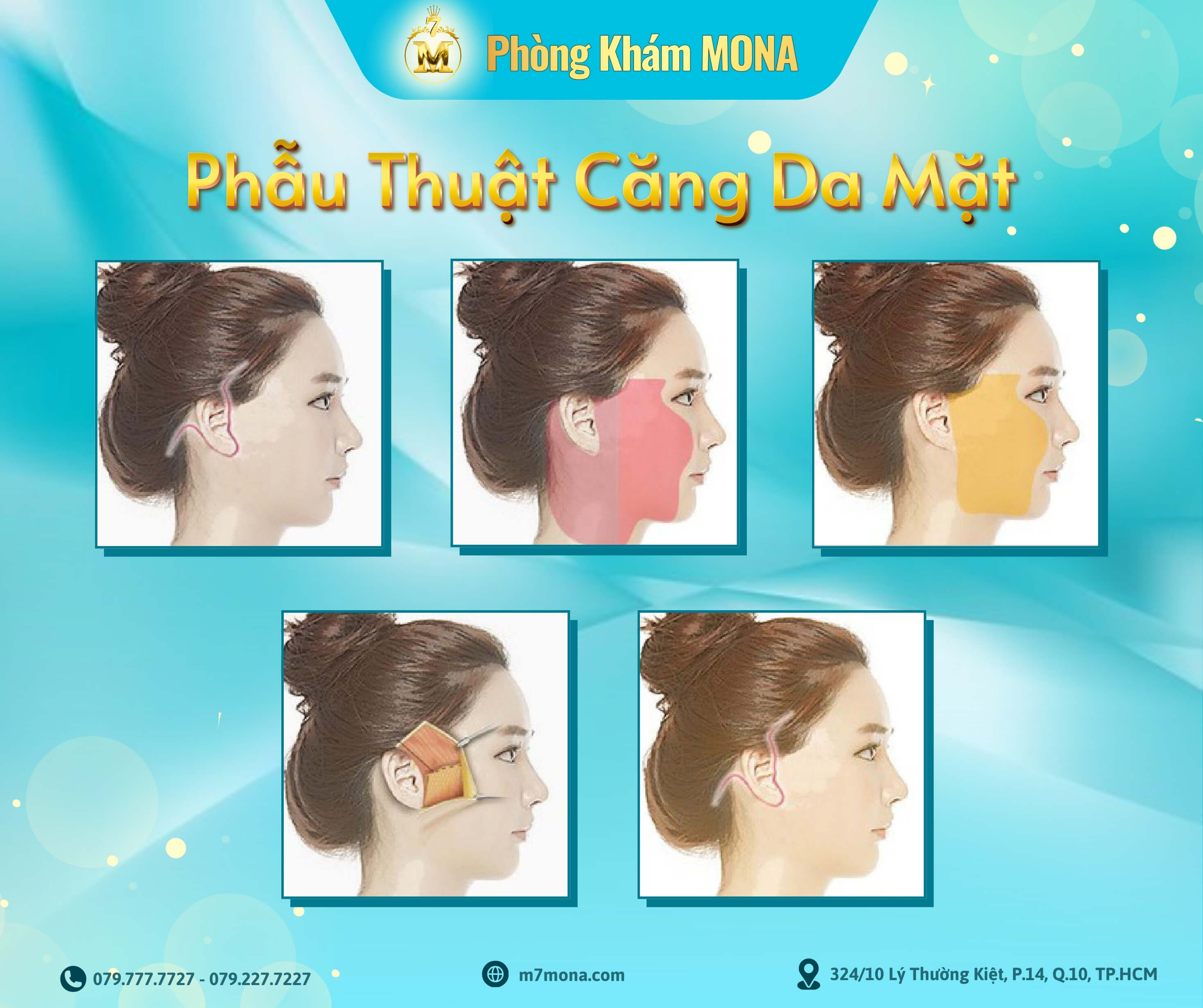 Qua trinh phau thuat cang da mat