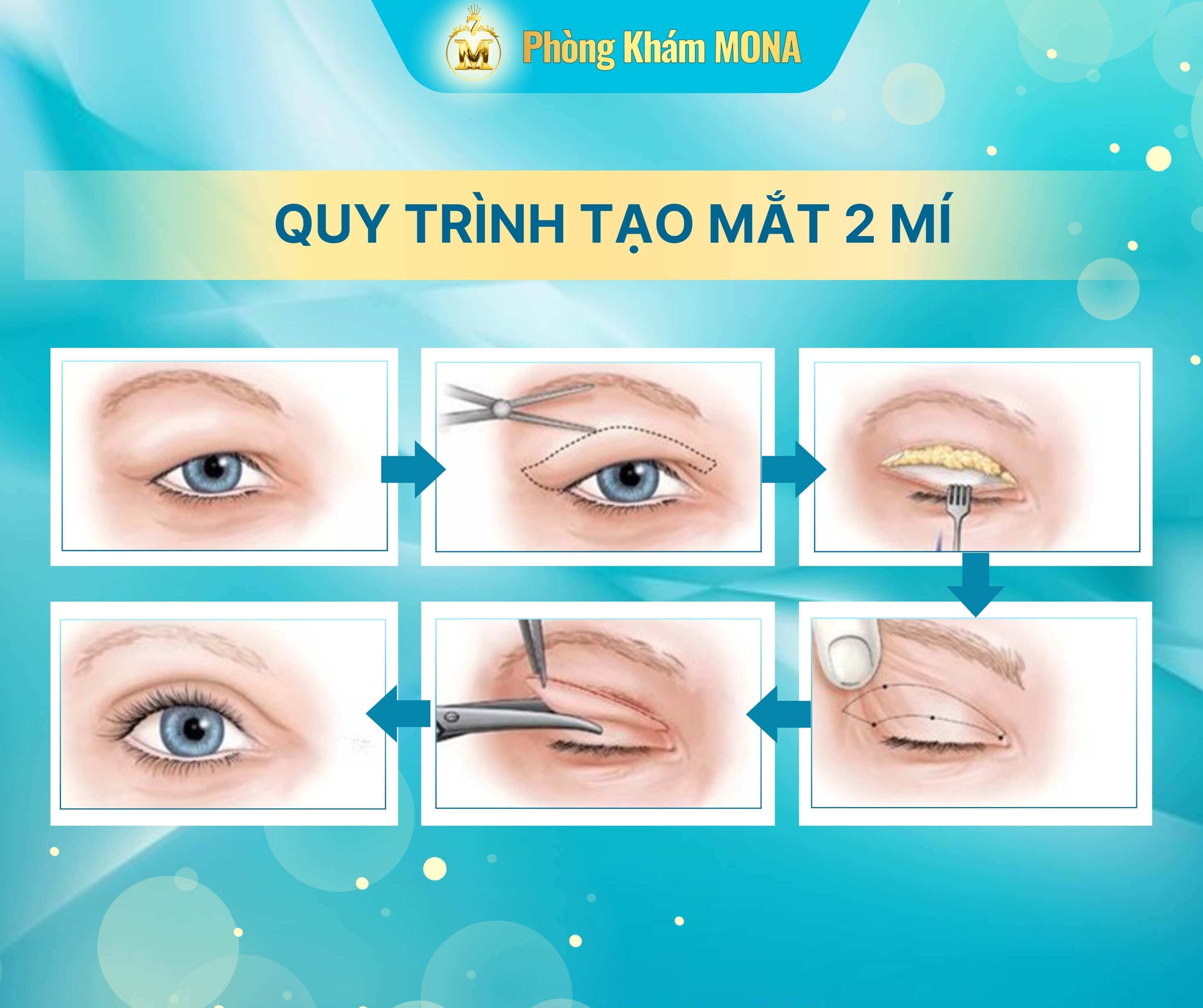 Quy trinh tao mat 2 mi