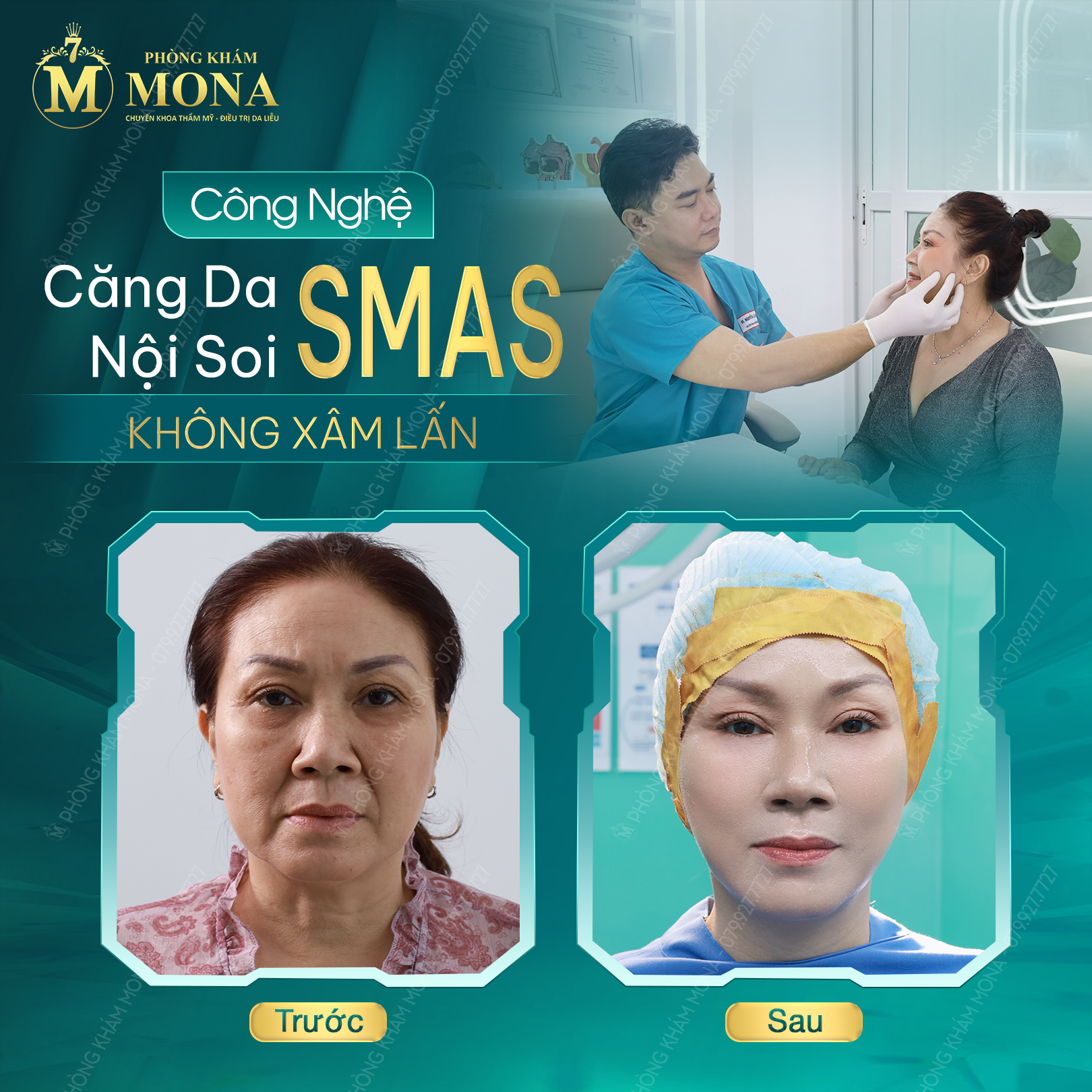 CĂNG DA MẶT SMAS