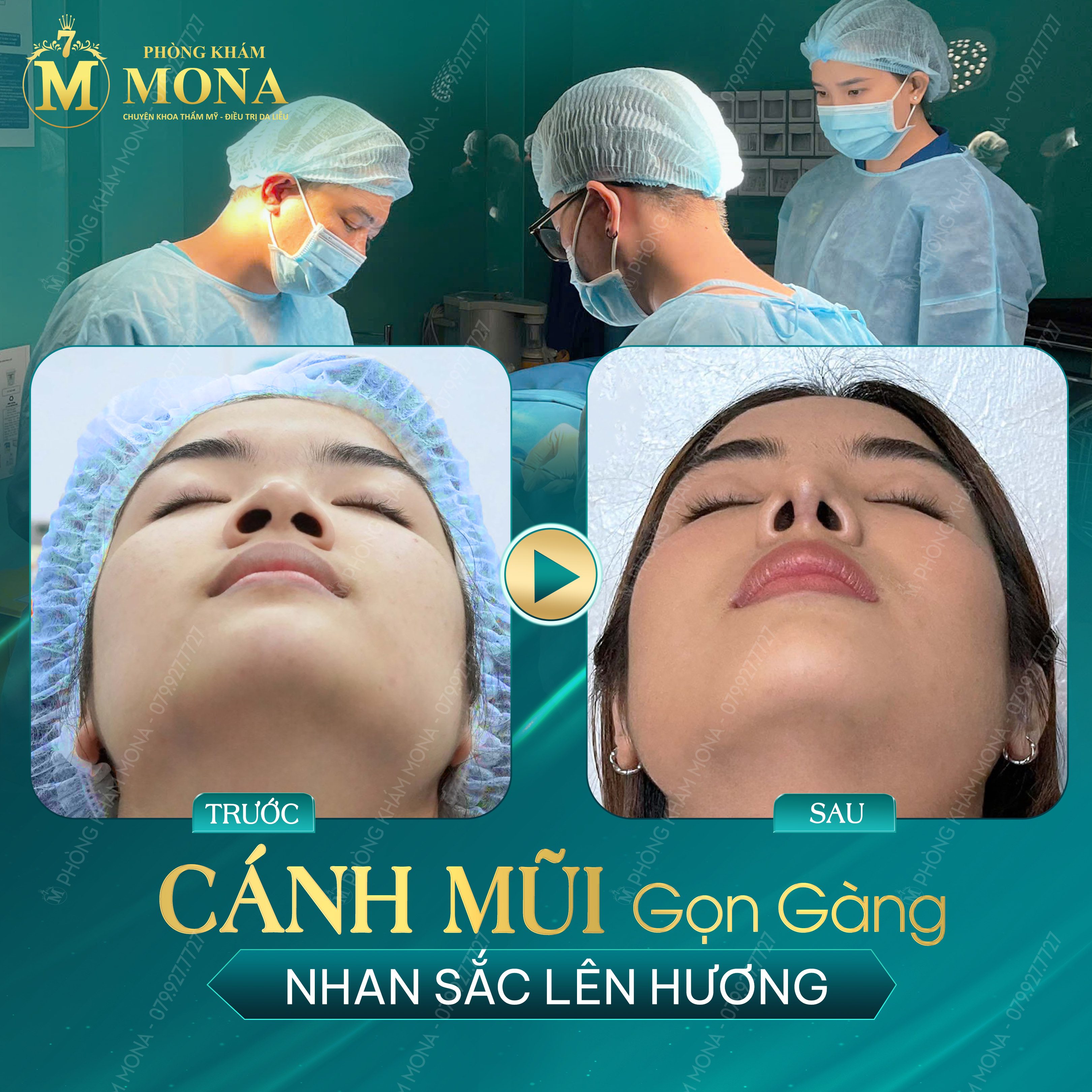 THU GỌN CÁNH MŨI