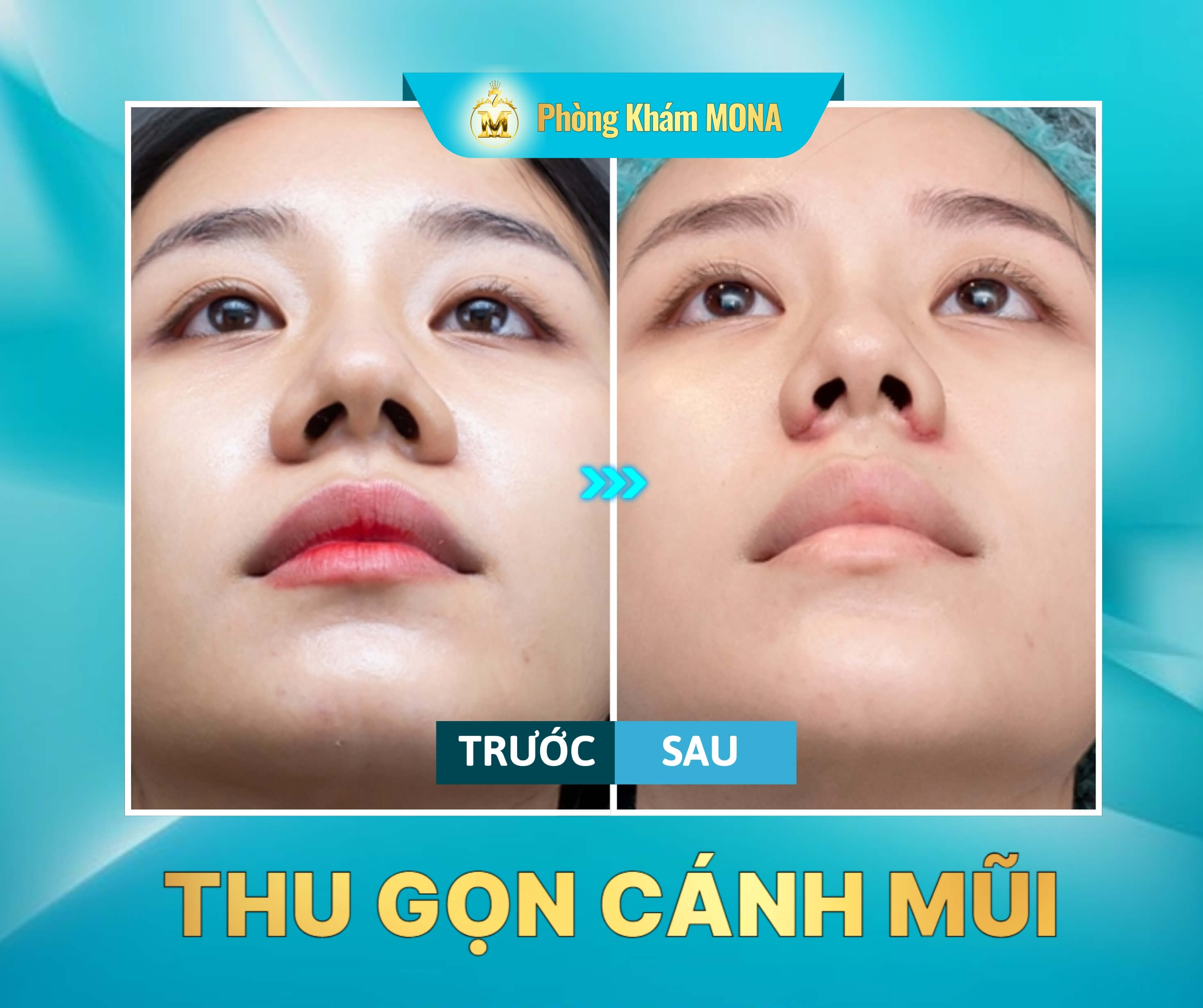 Truoc sau khi thu gon canh mui