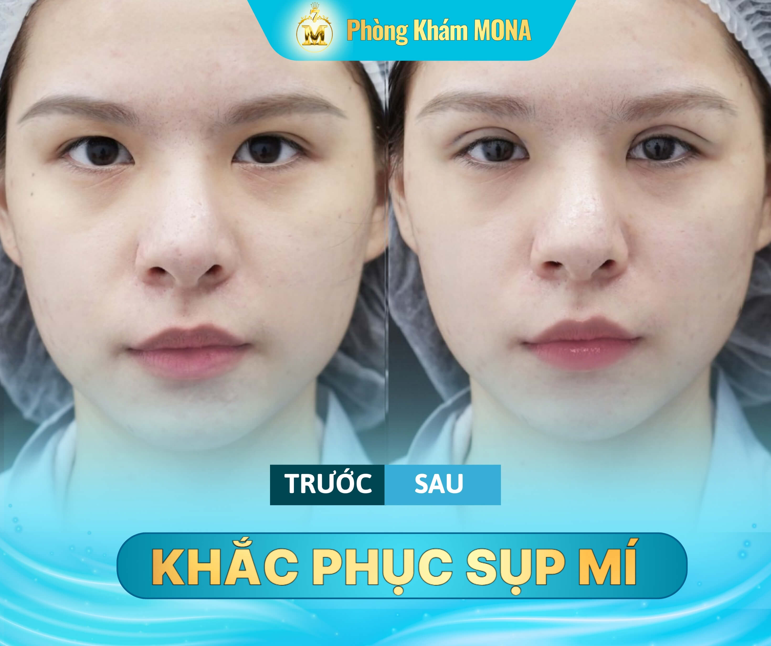 Truoc va sau khi khac phuc sup mi