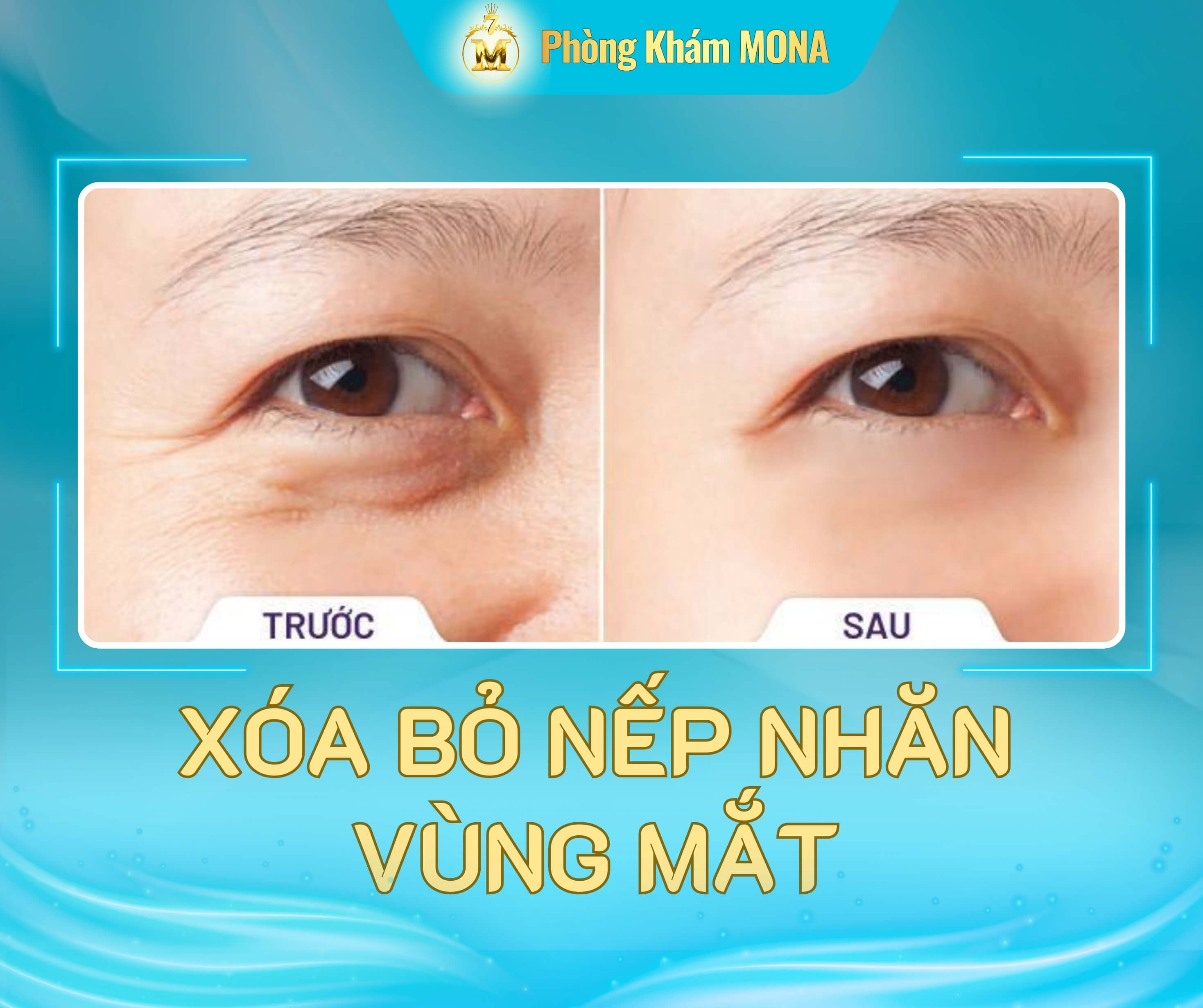 Xoa bo nep nhan vung mat