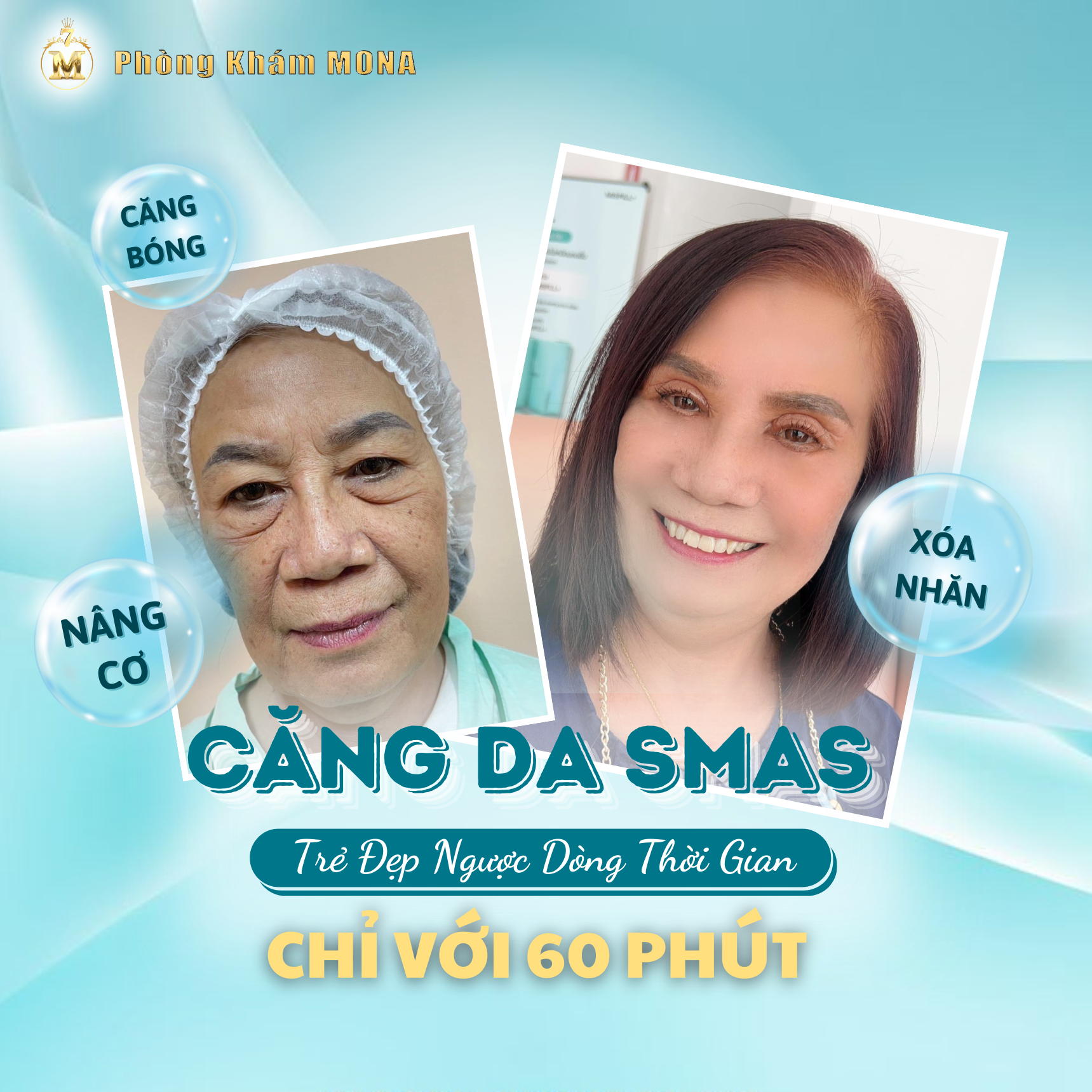 CĂNG DA MẶT SMAS