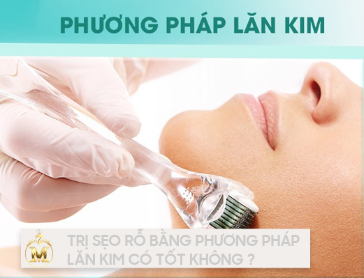 Lăn kim trị sẹo rỗ có TỐT không? Liệu trình như thế nào là phù hợp cho da mặt của bạn?