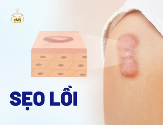 Sẹo lồi: Nguyên nhân, điều trị và cách phòng ngừa